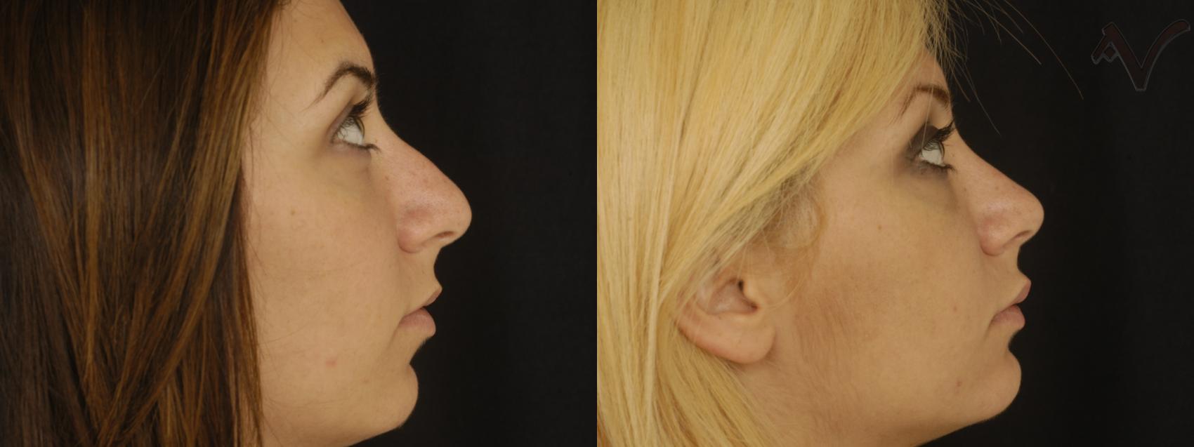 Before & After Rhinoplasty Case 196 Right Side View in Los Angeles, CA