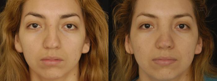 Before & After Rhinoplasty Case 199 Front View in Los Angeles, CA
