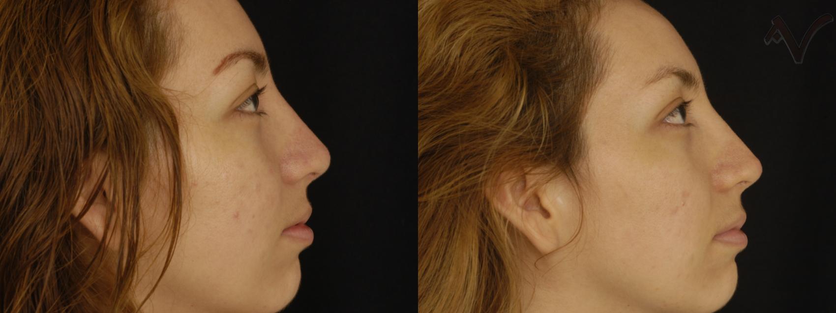 Before & After Rhinoplasty Case 199 Right Side View in Los Angeles, CA