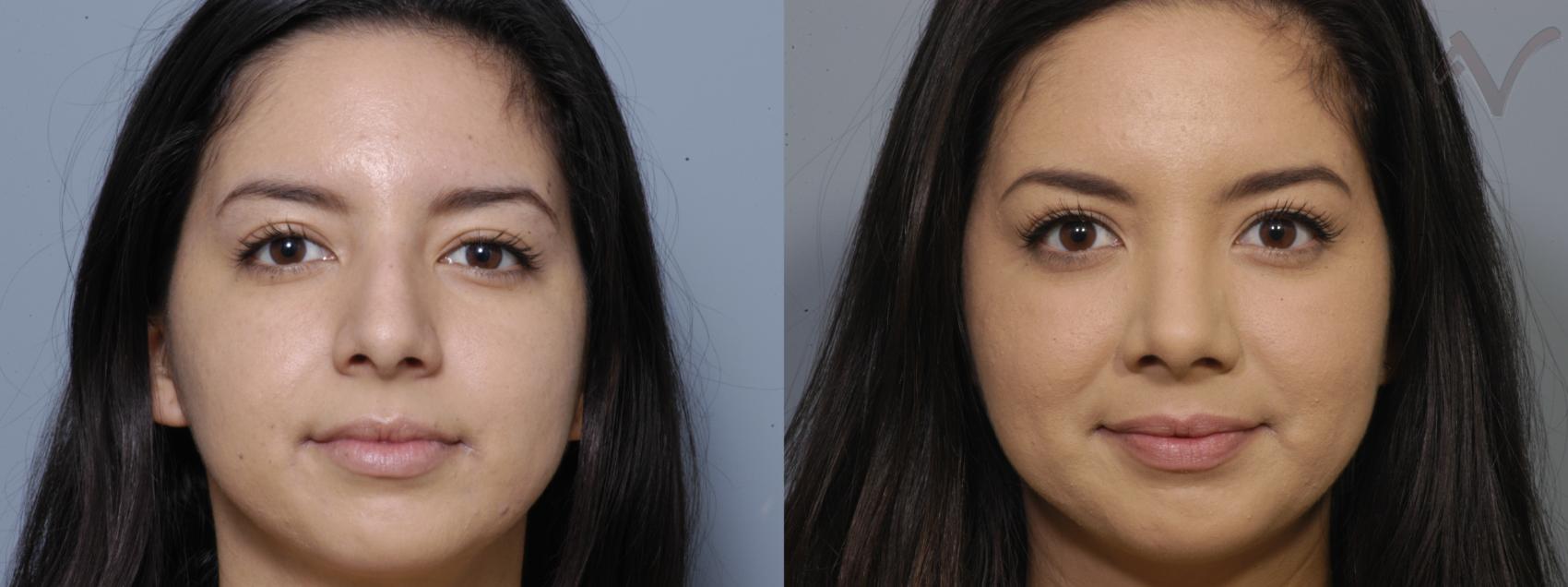 Before & After Rhinoplasty Case 2 Front View in Burbank, CA