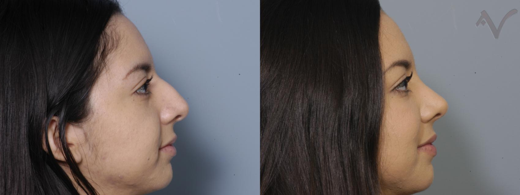 Before & After Rhinoplasty Case 2 Right Side View in Los Angeles, CA