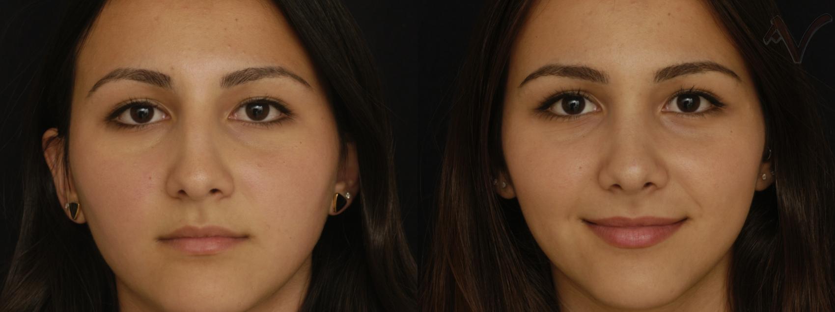 Before & After Rhinoplasty Case 213 Front View in Los Angeles, CA