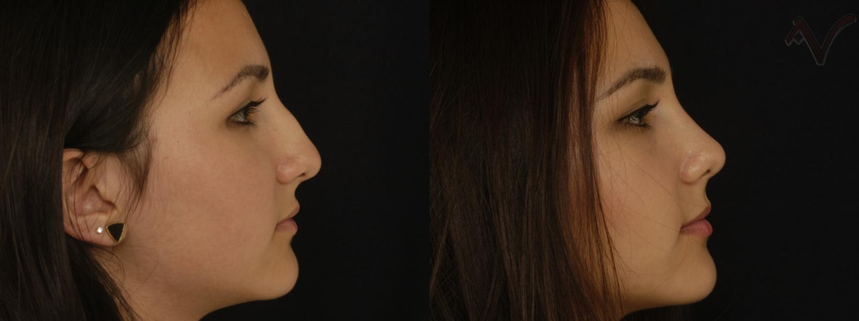 Before & After Rhinoplasty Case 213 Right Side View in Los Angeles, CA