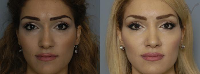 Before & After Rhinoplasty Case 217 Front View in Los Angeles, CA