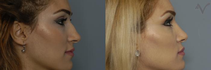 Before & After Rhinoplasty Case 217 Right Side View in Los Angeles, CA