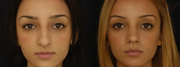 Before & After Rhinoplasty Case 219 Front View in Los Angeles, CA
