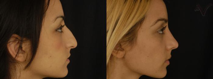 Before & After Rhinoplasty Case 219 Right Side View in Los Angeles, CA