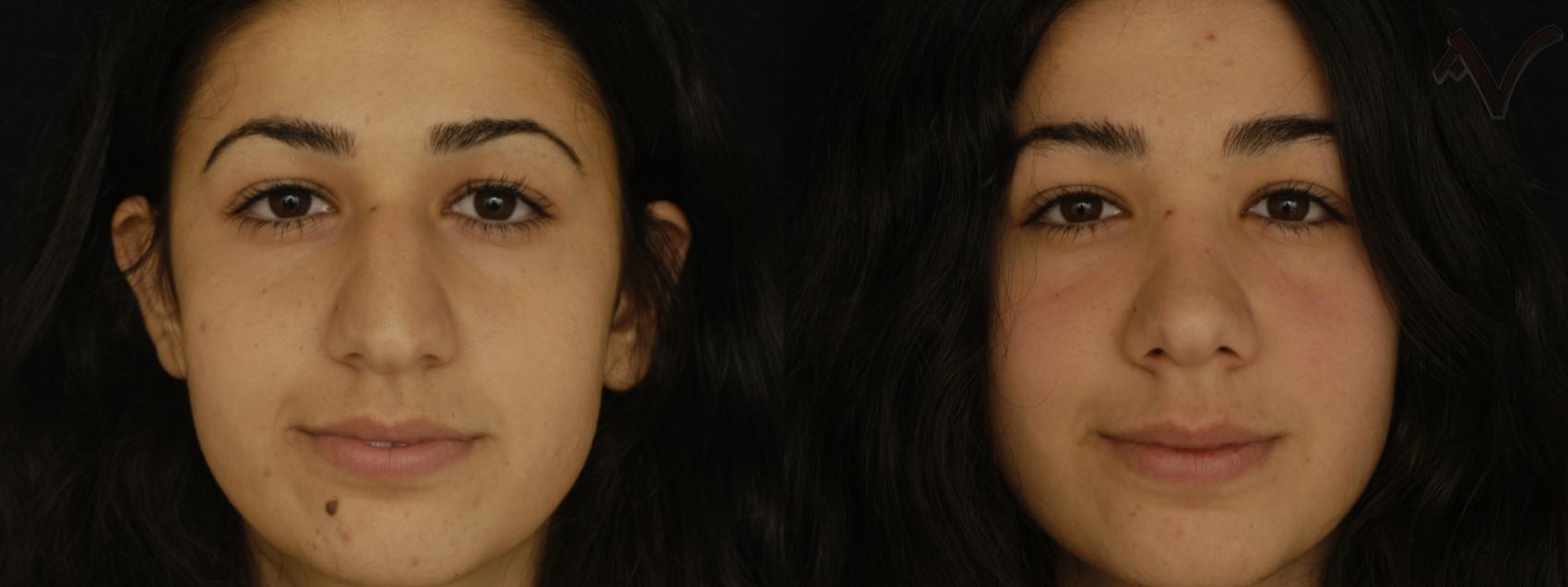 Before & After Rhinoplasty Case 220 Front View in Los Angeles, CA