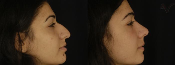 Before & After Rhinoplasty Case 220 Right Side View in Los Angeles, CA