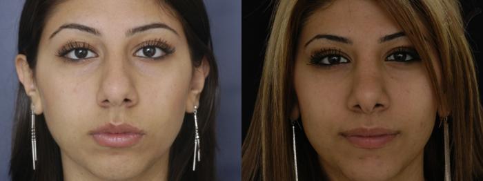 Before & After Rhinoplasty Case 222 Front View in Los Angeles, CA