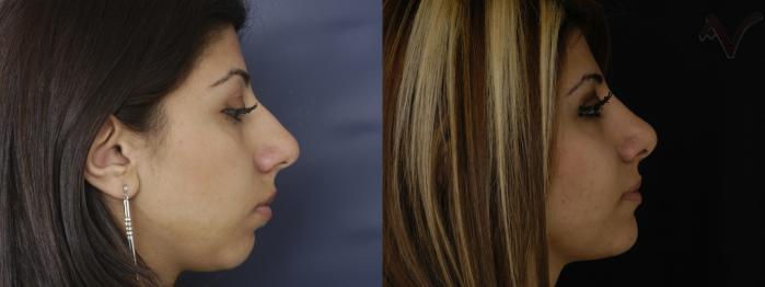 Before & After Rhinoplasty Case 222 Right Side View in Los Angeles, CA