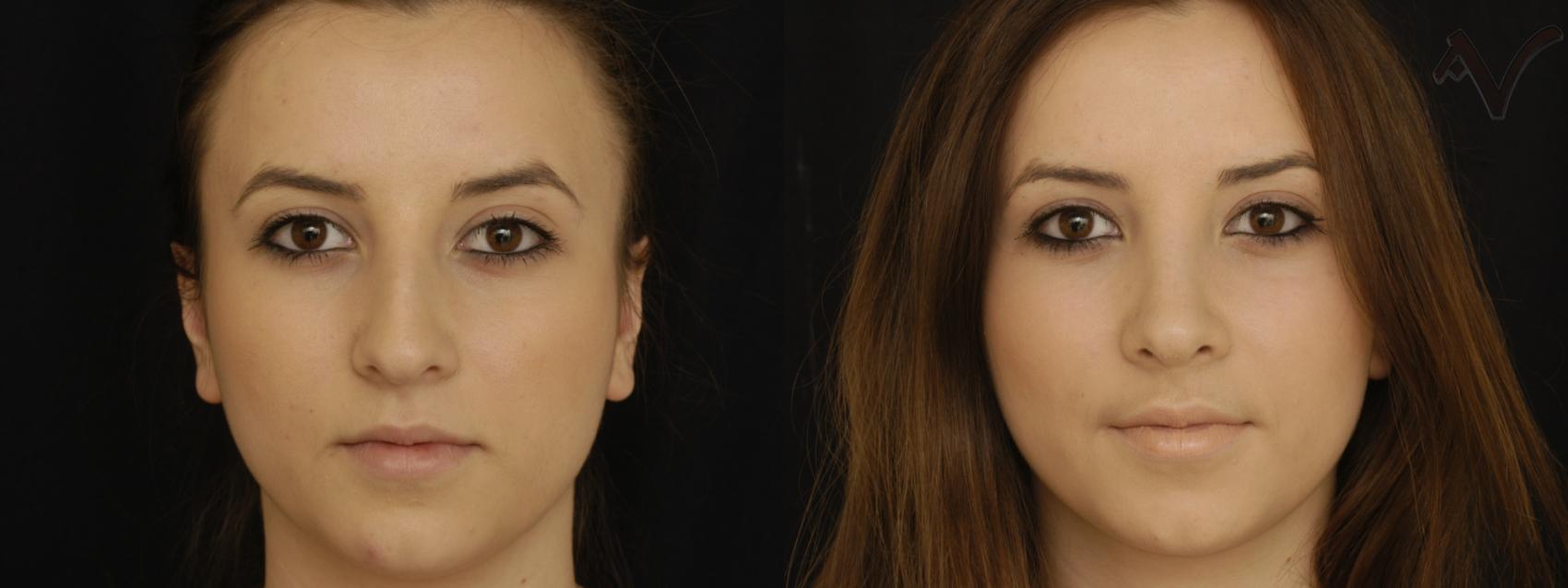 Before & After Rhinoplasty Case 223 Front View in Los Angeles, CA