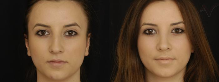 Before & After Rhinoplasty Case 223 Front View in Los Angeles, CA