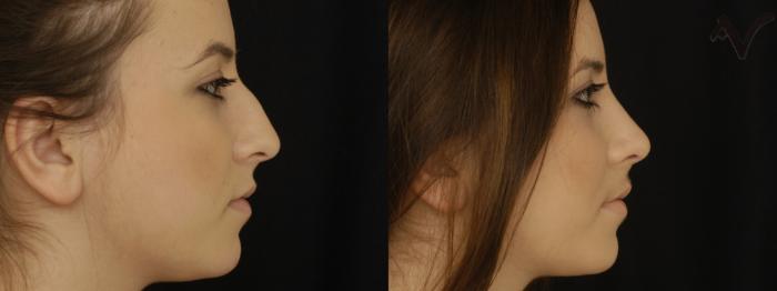Before & After Rhinoplasty Case 223 Right Side View in Los Angeles, CA