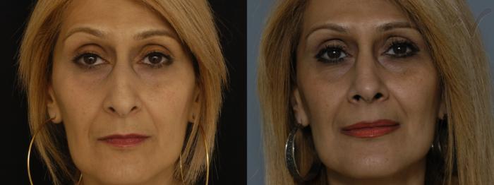 Before & After Rhinoplasty Case 224 Front View in Los Angeles, CA