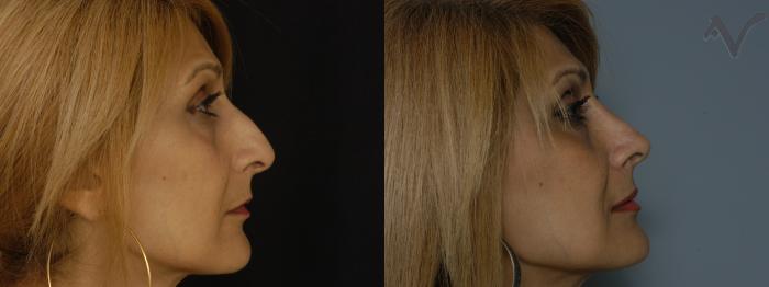 Before & After Rhinoplasty Case 224 Right Side View in Los Angeles, CA