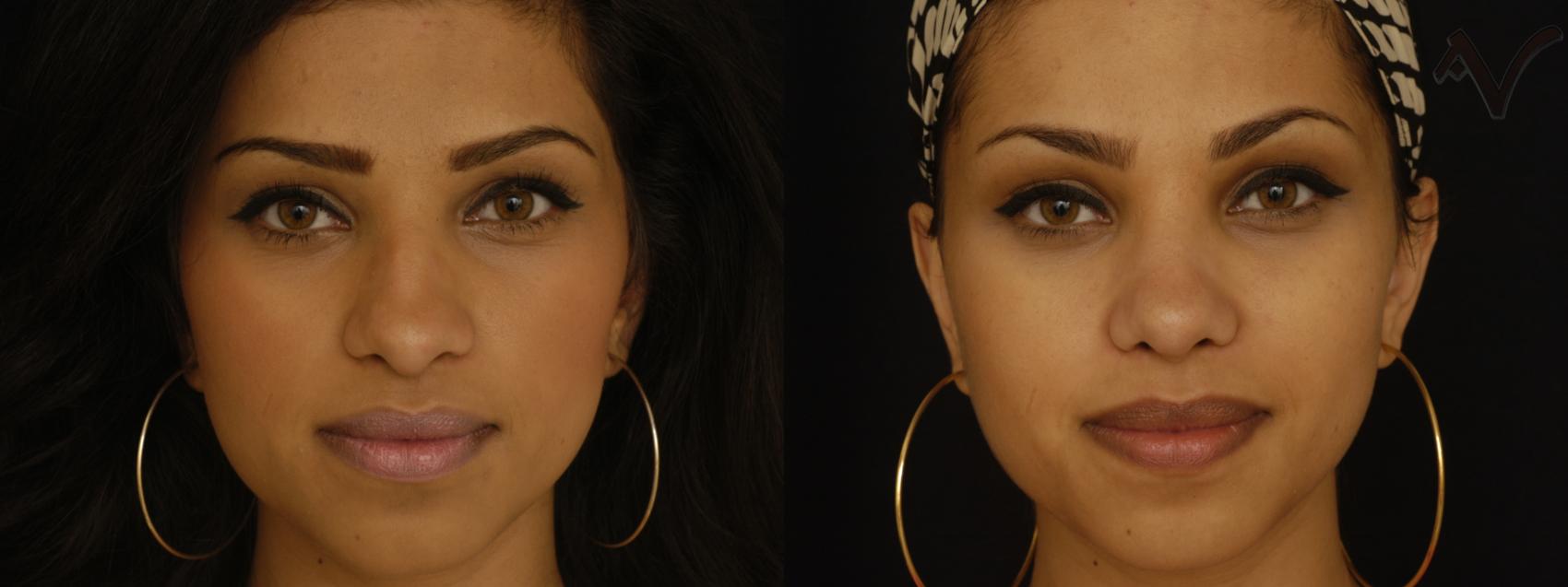 Before & After Rhinoplasty Case 226 Front View in Burbank, CA