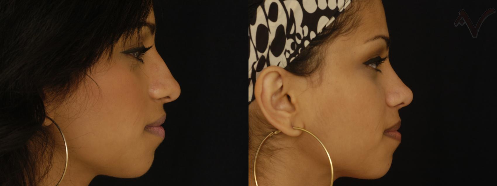 Before & After Rhinoplasty Case 226 Right Side View in Burbank, CA