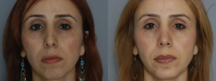 Before & After Rhinoplasty Case 228 Front View in Los Angeles, CA