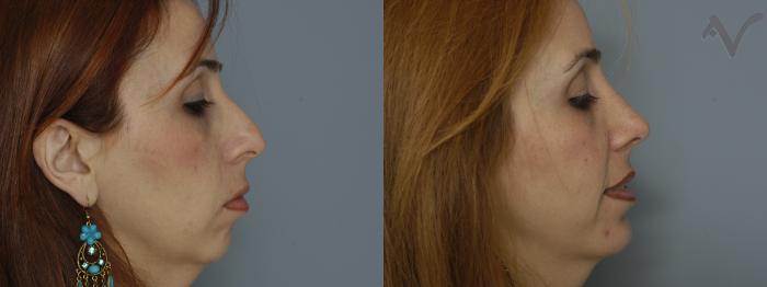 Before & After Rhinoplasty Case 228 Right Side View in Los Angeles, CA