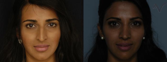 Before & After Rhinoplasty Case 229 Front View in Los Angeles, CA