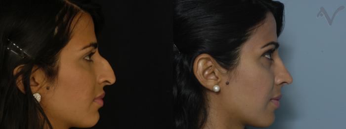 Before & After Rhinoplasty Case 229 Right Side View in Los Angeles, CA