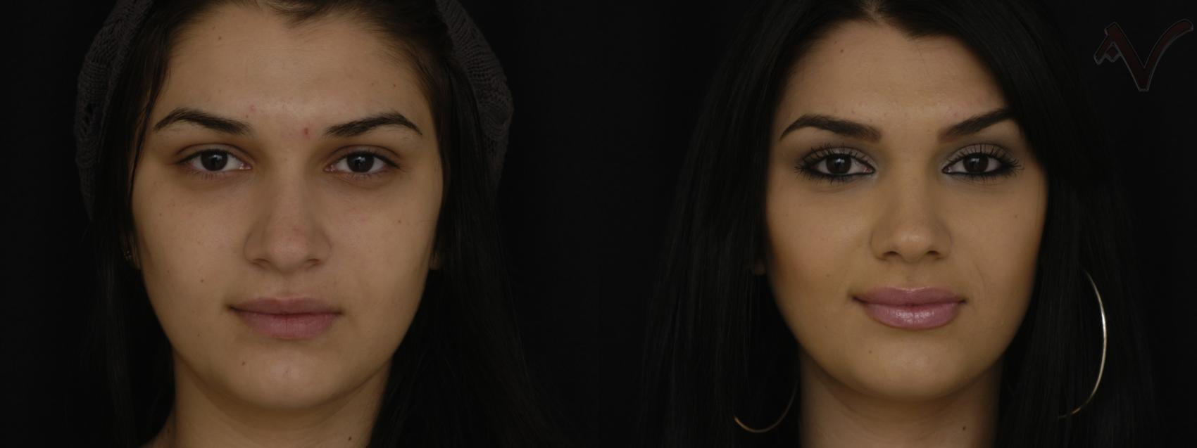 Before & After Rhinoplasty Case 232 Front View in Los Angeles, CA