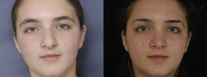 Before & After Rhinoplasty Case 255 Front View in Los Angeles, CA