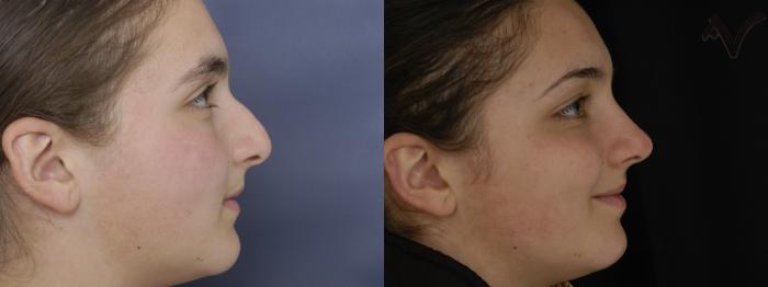 Before & After Rhinoplasty Case 255 Right Side View in Los Angeles, CA