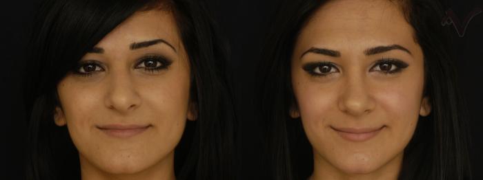 Before & After Rhinoplasty Case 256 Front View in Los Angeles, CA