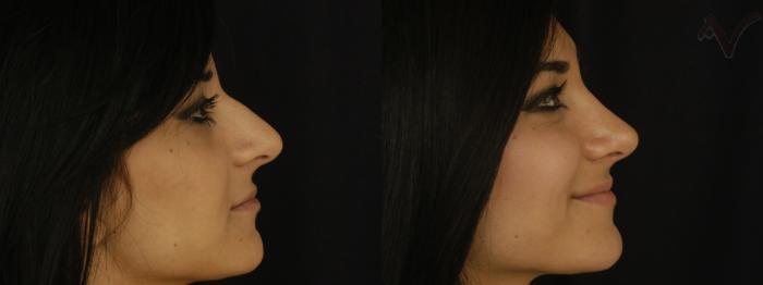 Before & After Rhinoplasty Case 256 Right Side View in Los Angeles, CA
