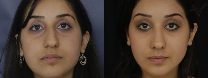 Before & After Rhinoplasty Case 257 Front View in Los Angeles, CA
