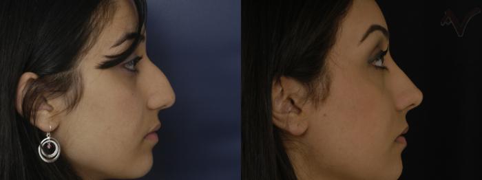 Before & After Rhinoplasty Case 257 Right Side View in Los Angeles, CA