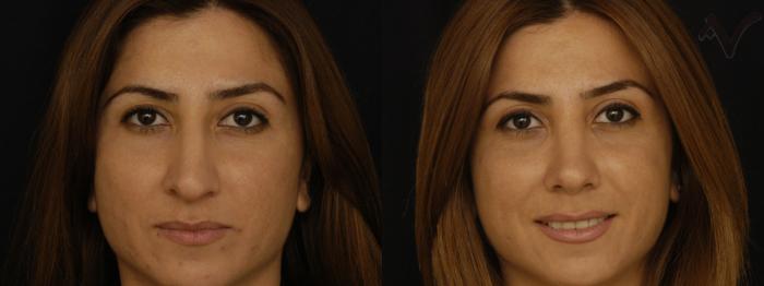 Before & After Rhinoplasty Case 258 Front View in Los Angeles, CA