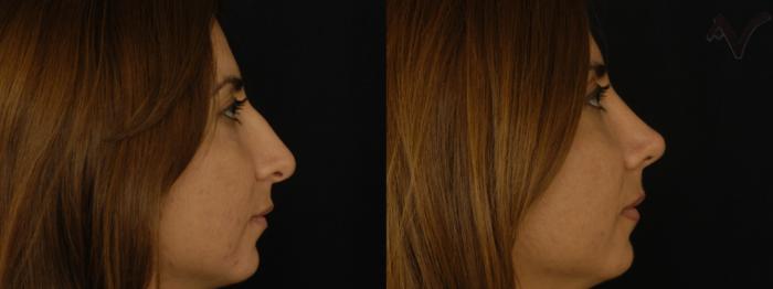 Before & After Rhinoplasty Case 258 Right Side View in Los Angeles, CA