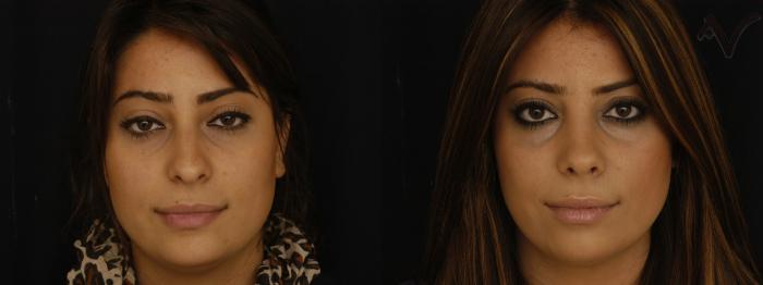 Before & After Rhinoplasty Case 259 Front View in Los Angeles, CA