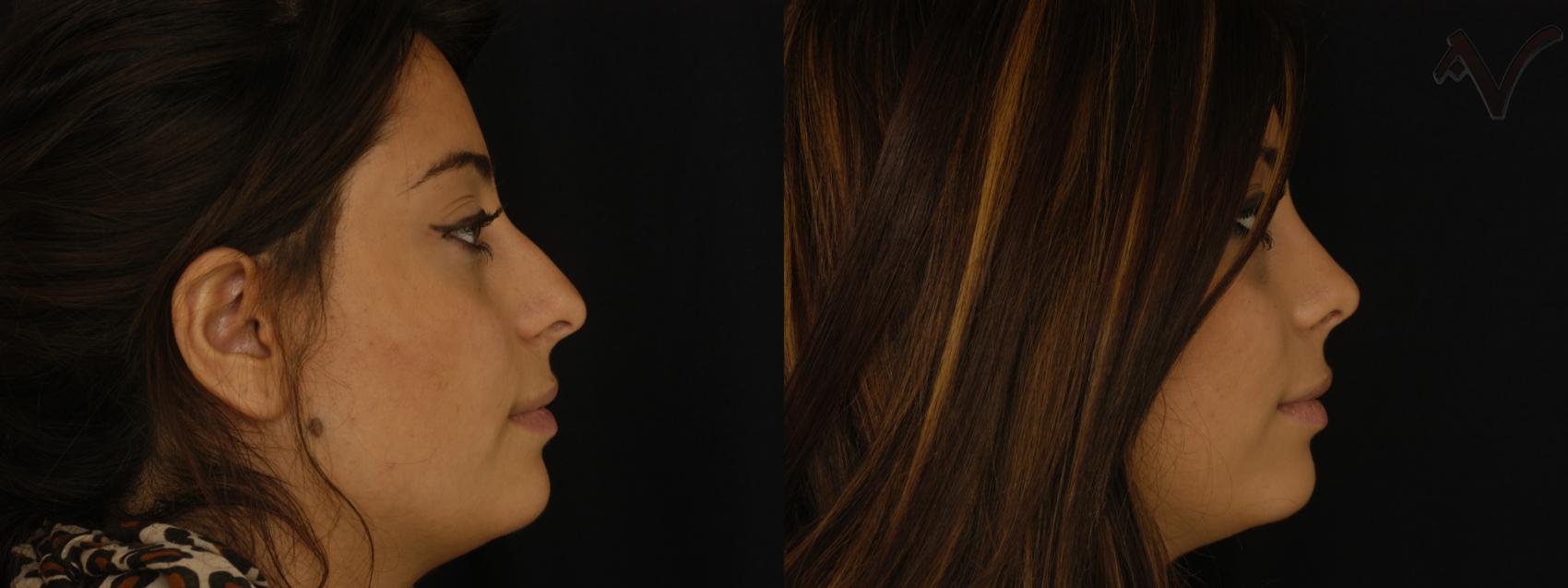 Before & After Rhinoplasty Case 259 Right Side View in Burbank, CA