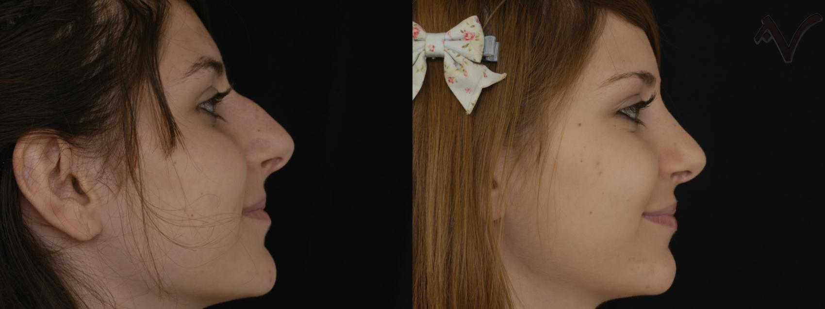 Before & After Rhinoplasty Case 261 Right Side View in Burbank, CA