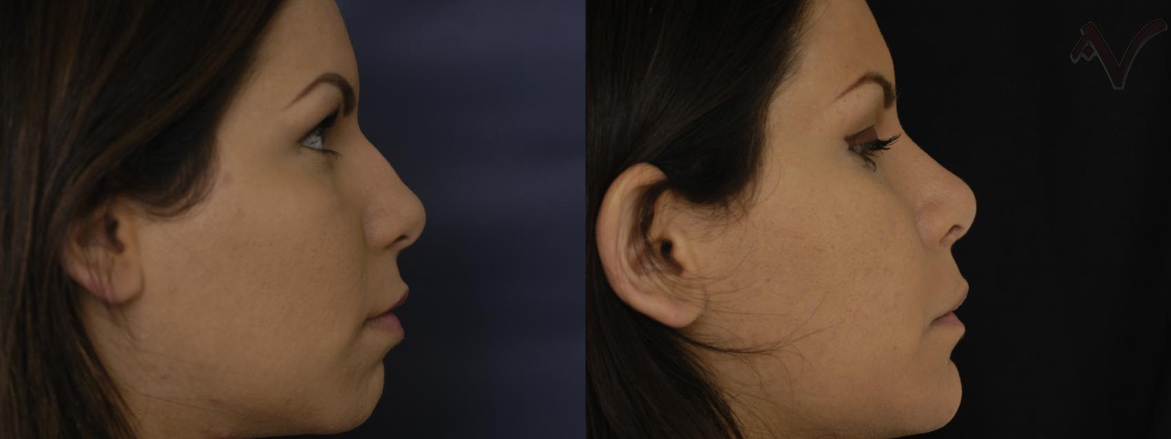Before & After Rhinoplasty Case 262 Right Side View in Los Angeles, CA