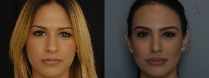 Before & After Rhinoplasty Case 288 Front View in Los Angeles, CA