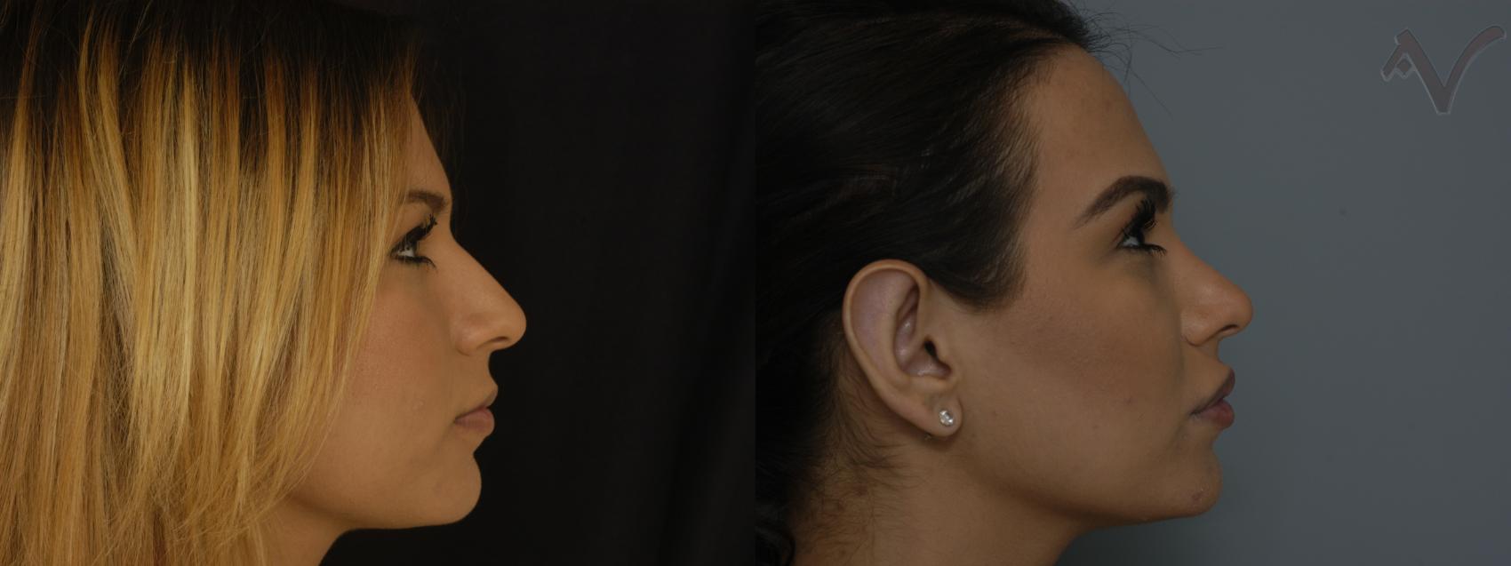 Before & After Rhinoplasty Case 288 Right Side View in Los Angeles, CA