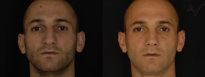 Before & After Rhinoplasty Case 292 Front View in Los Angeles, CA