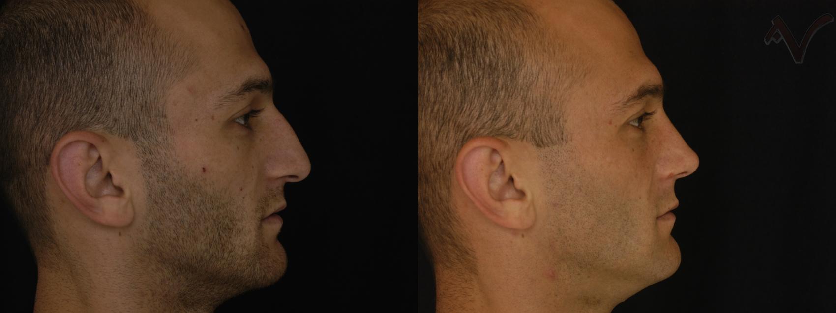 Before & After Rhinoplasty Case 292 Right Side View in Los Angeles, CA