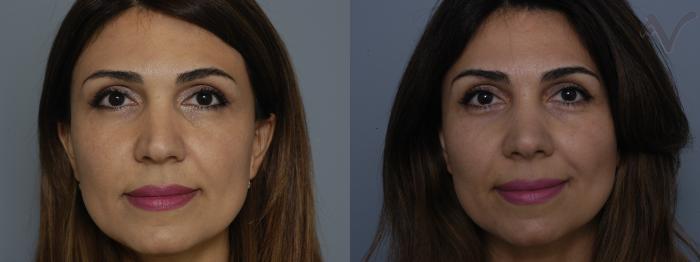 Before & After Rhinoplasty Case 293 Front View in Los Angeles, CA