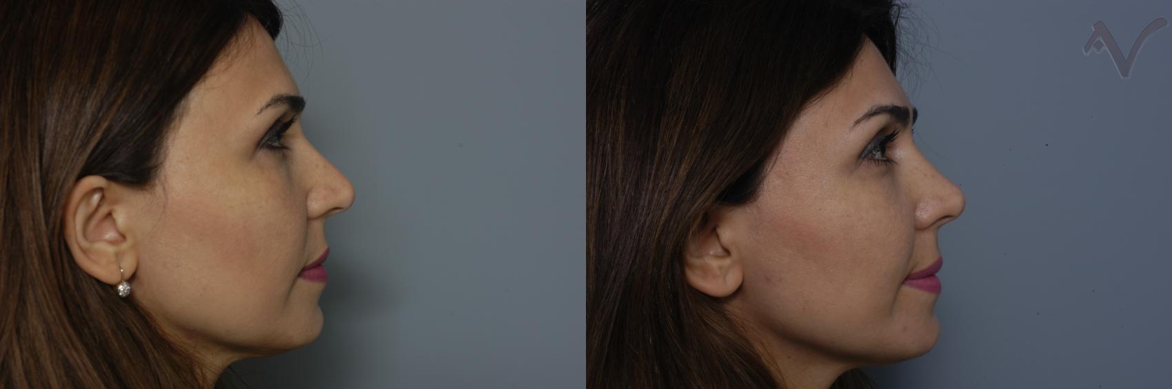 Before & After Rhinoplasty Case 293 Right Side View in Los Angeles, CA