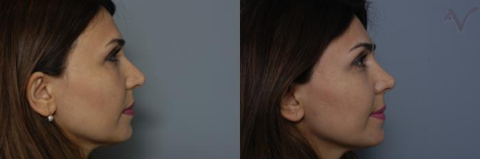 Before & After Rhinoplasty Case 293 Right Side View in Los Angeles, CA