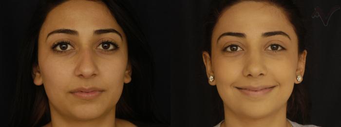 Before & After Rhinoplasty Case 295 Front View in Los Angeles, CA