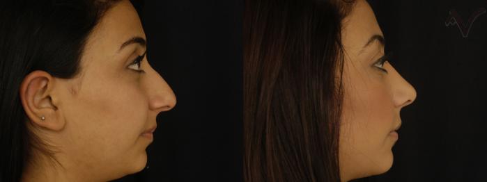Before & After Rhinoplasty Case 295 Right Side View in Los Angeles, CA