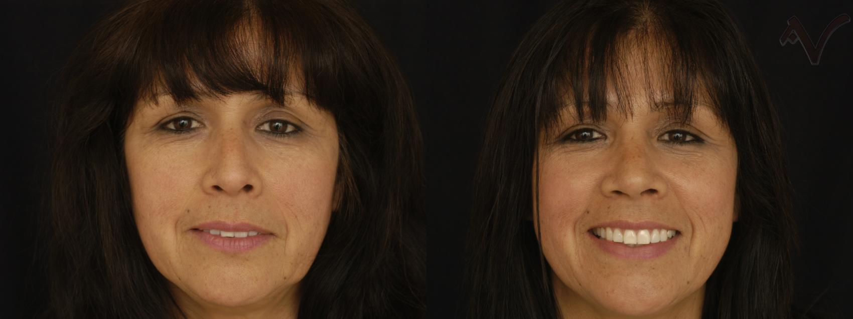 Before & After Rhinoplasty Case 296 Front View in Los Angeles, CA