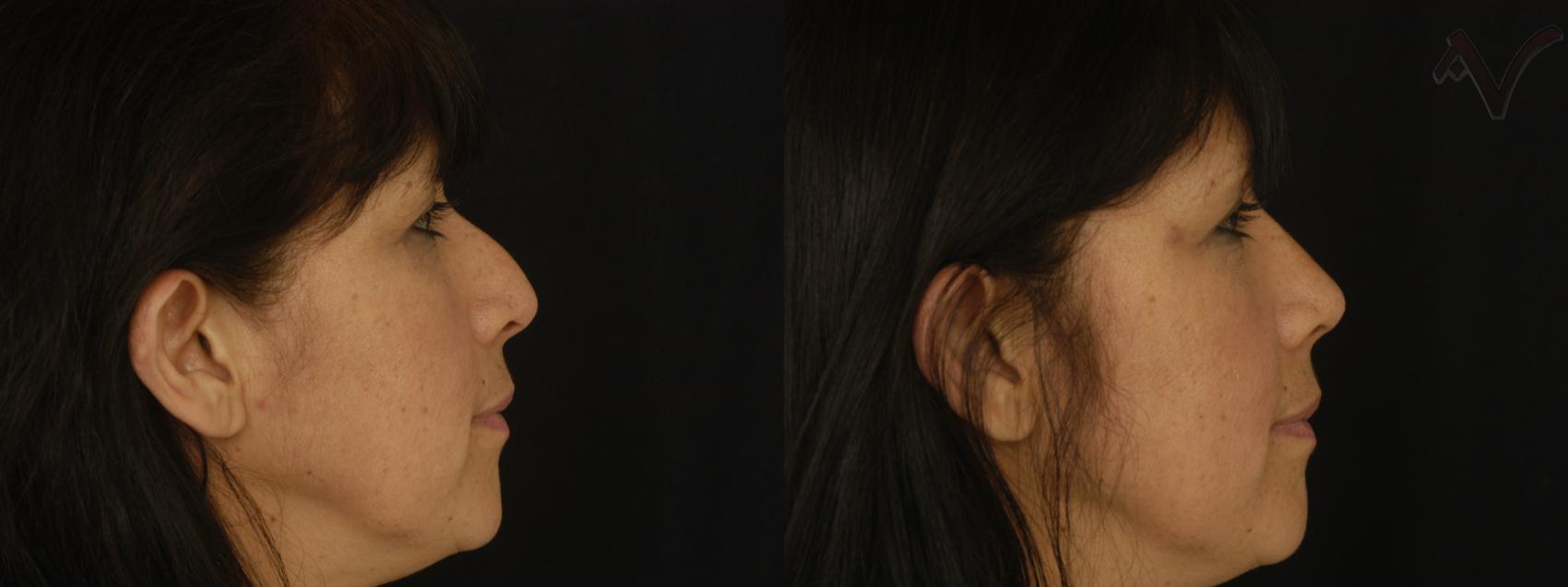 Before & After Rhinoplasty Case 296 Right Side View in Los Angeles, CA